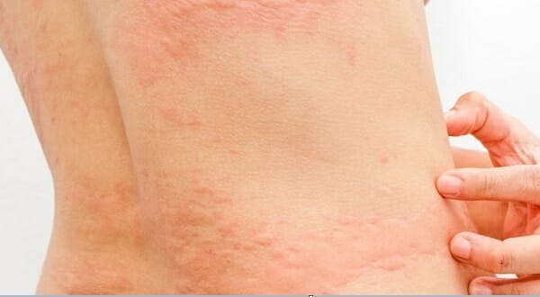 Виды аллергических сыпей у детей и методы их лечения