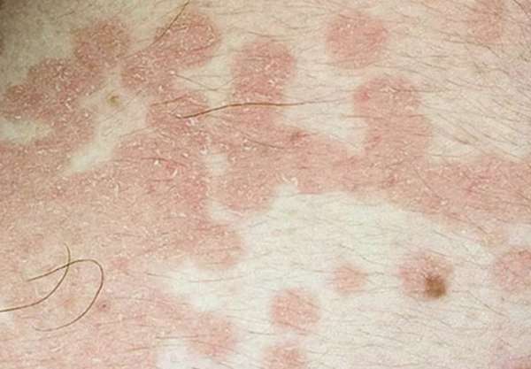 Почему образуются бляшки на коже, возможные причины, лечение