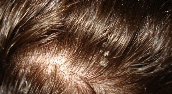 Струпья на коже головы лечение thumbnail
