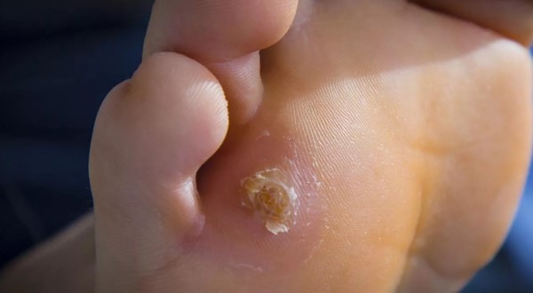 Мозоль на пальце ноги: виды и причины наростов, как лечить водяную и стержневую мозоль