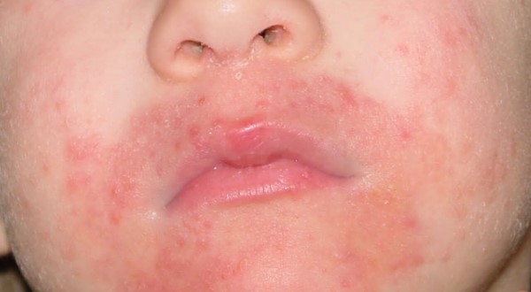Аллергия вокруг рта у ребенка чем thumbnail