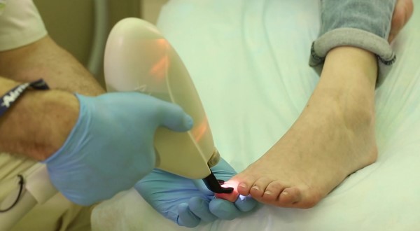 Анализы крови для лечения грибка ногтей thumbnail
